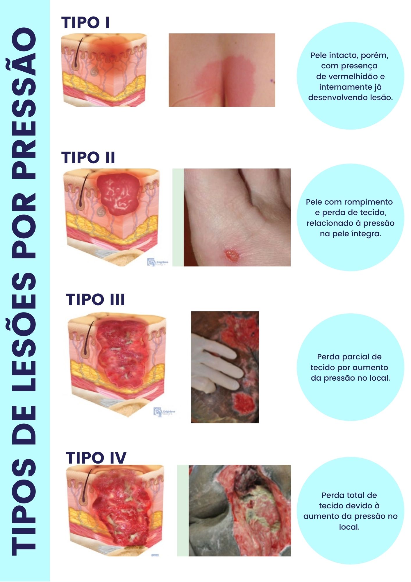 Infográfico dos tipos de lesões na pele