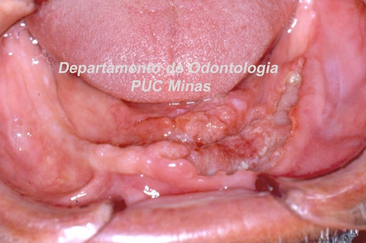 Exemplos: Carcinoma espinocelular, úlcera traumática. 