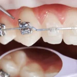 Paciente com aparelho ortodôntico tomando cuidado ao ajustar os braquetes nos dentes superiores durante o tratamento orthodontic.