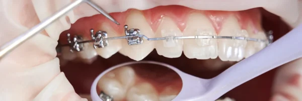 Paciente com aparelho ortodôntico tomando cuidado ao ajustar os braquetes nos dentes superiores durante o tratamento orthodontic.