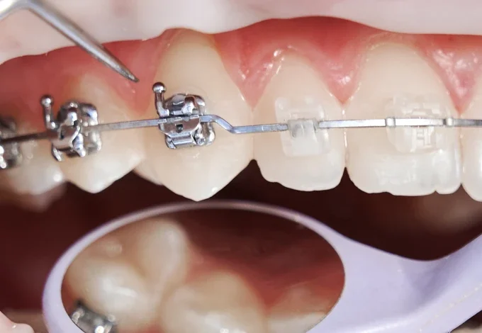 Paciente com aparelho ortodôntico tomando cuidado ao ajustar os braquetes nos dentes superiores durante o tratamento orthodontic.