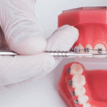 Conheça as Diferenças de Fios Ortodônticos - Blog Dental Speed