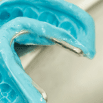 Passo a passo de moldagem ortodôntica