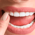 Retração gengival: causas e tratamentos