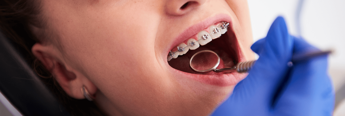 Alinhador ortodôntico Invisível, tendência na ortodontia moderna