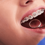 Quando indicar aparelho autoligado para os pacientes?