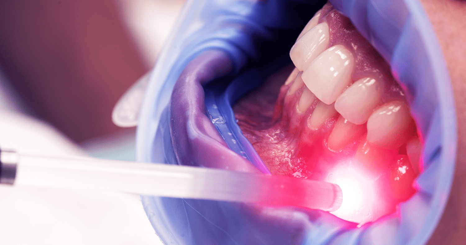Os benefícios da Laserterapia na Odontologia