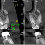 extracao artigo dra carla