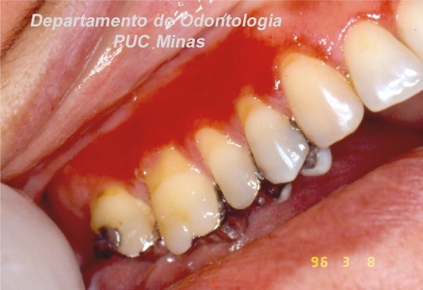 Les Es Fundamentais Na Mucosa Oral Blog Dental Speed
