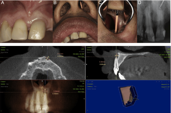 tomografia computadorizada em endodontia
