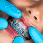 Aparelhos Ortodônticos em crianças: Quando indicar?