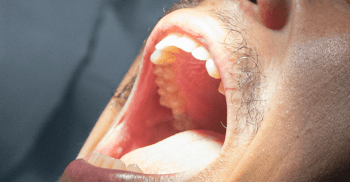 Biópsia na Odontologia: passo a passo
