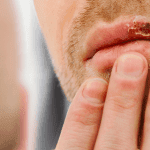 Herpesvírus humano: tipos, manifestações orais e tratamento