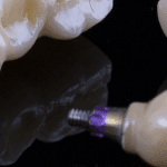 Implante Imediato: tipos de enxerto para preenchimento do “gap”