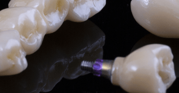 Implante Imediato: tipos de enxerto para preenchimento do “gap”