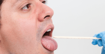 Lesões na língua: Diagnóstico e tratamento