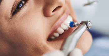Clareamento dental após a remoção do aparelho ortodôntico fixo
