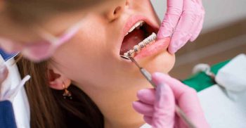 Ortodontia para adultos: quando, por que e como?