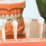 manequim arcada dentária com conjunto de dentes de amostragem blog dental speed