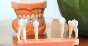 Efeito da radioterapia na dentina radicular e em cimentos obturadores