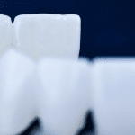 restaurações provisórias