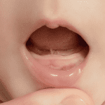 Frenectomia x Frenotomia Veja as principais diferenças