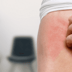 Atenção odontológica à pacientes portadores de hanseníase﻿﻿