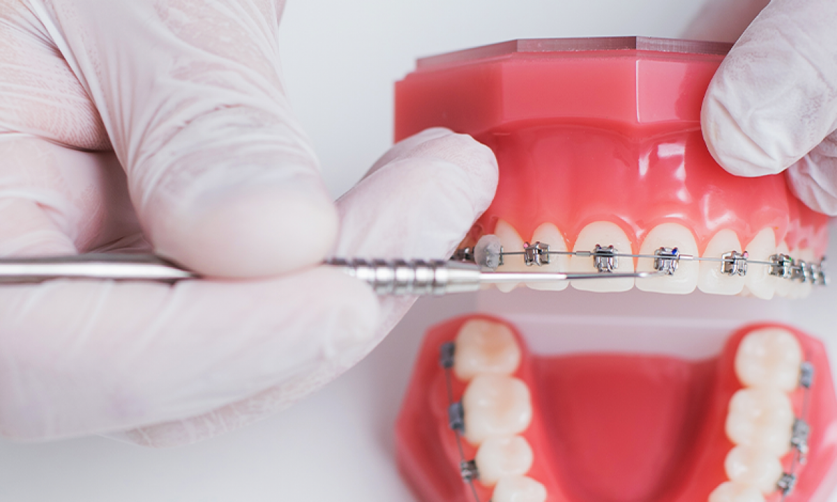 O que é ortodontia e quais tratamento ela abrange? Vamos te contar