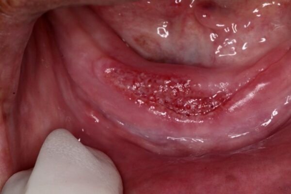Infecções Fúngicas na Odontologia- Blog Dental Speed