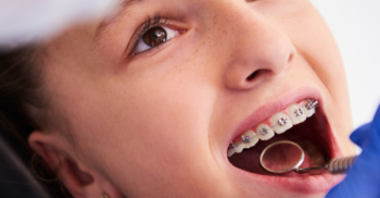 Saiba tudo sobre a relação entre ortodontia e oclusão dentária