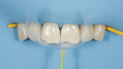 caso clínico de clareamento