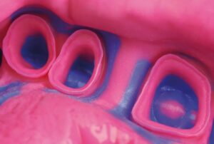 Silicone de adição e moldagens de alta precisão