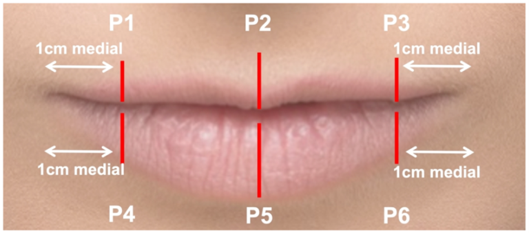 Imagem esquemática dos lábios com marcações em vermelho P1 a P6 e medidas indicando 1 cm medial, mostrando áreas de referência para avaliação anatômica.