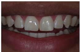 Na última figura, podemos observar o resultado da reabilitação estética pós frenectomia labial.