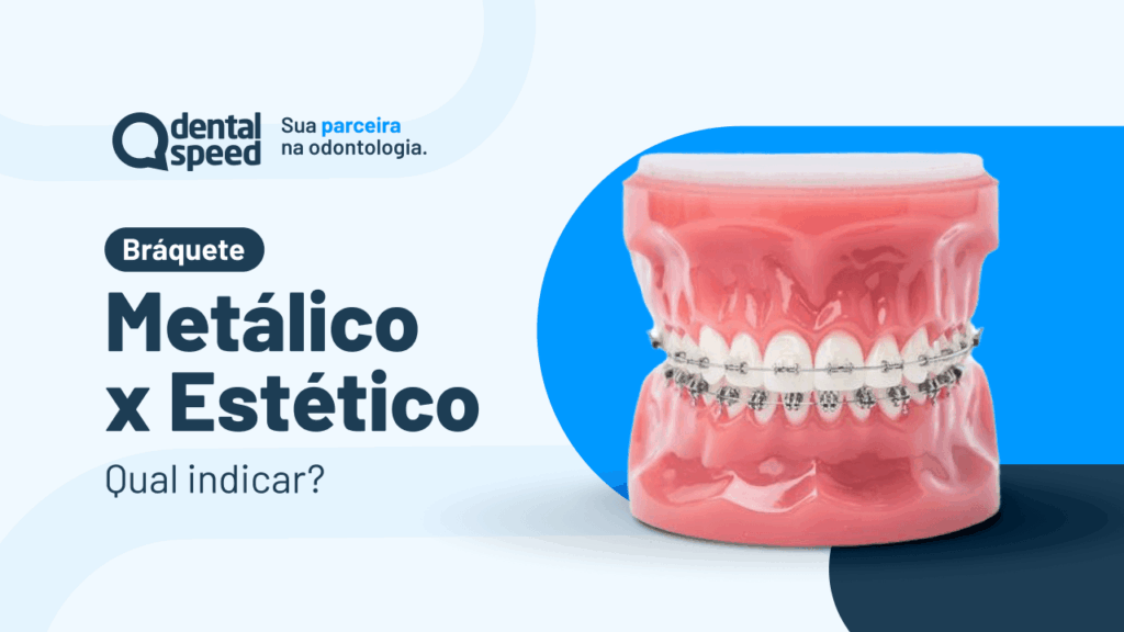 Br&aacute;quetes Met&aacute;licos vs. Est&eacute;ticos
