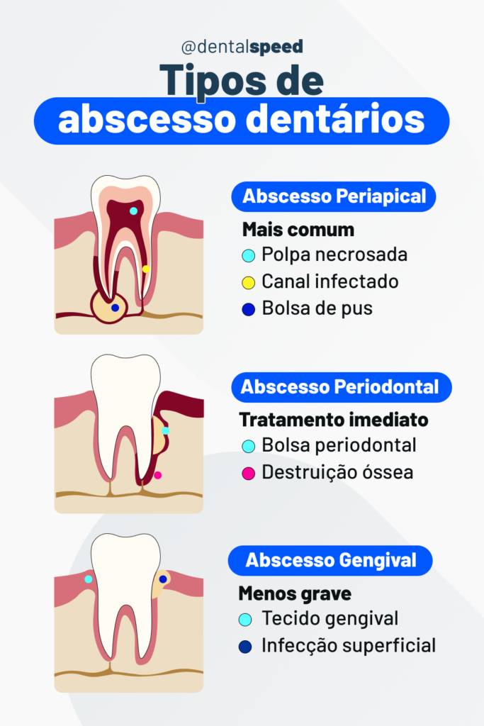Infográfico odontológico com o tema “Tipos de abscesso dentários”, mostrando ilustrações de abscesso periapical, periodontal e gengival, com sintomas como polpa necrosada, canal infectado, bolsa de pus, bolsa periodontal e destruição óssea, além de infecção superficial.