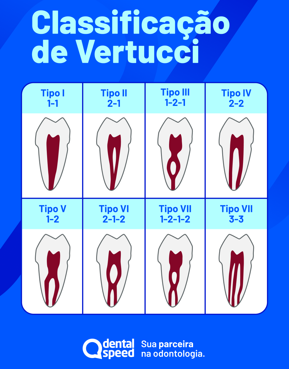 Infográfico sobre classificação de vertucação no dente com tipos I a VII (1-1, 2-1-1, 1-2-1, 2-2, 1-2, 2-1-2 e 3-3) e ilustrações dos dentes